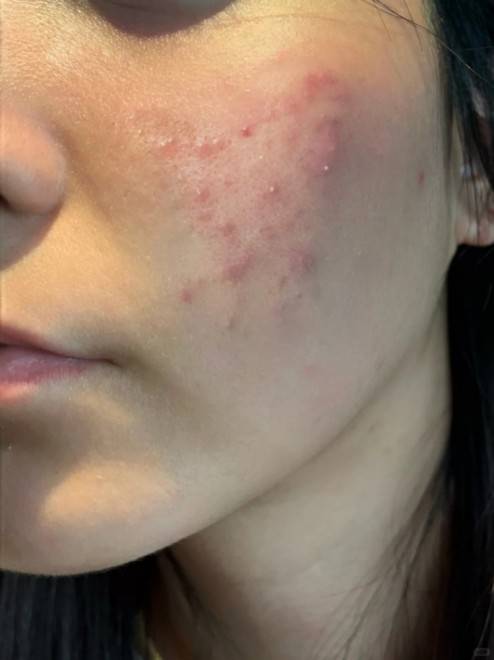 哪种洗面奶控油祛痘??痘肌清爽超给力