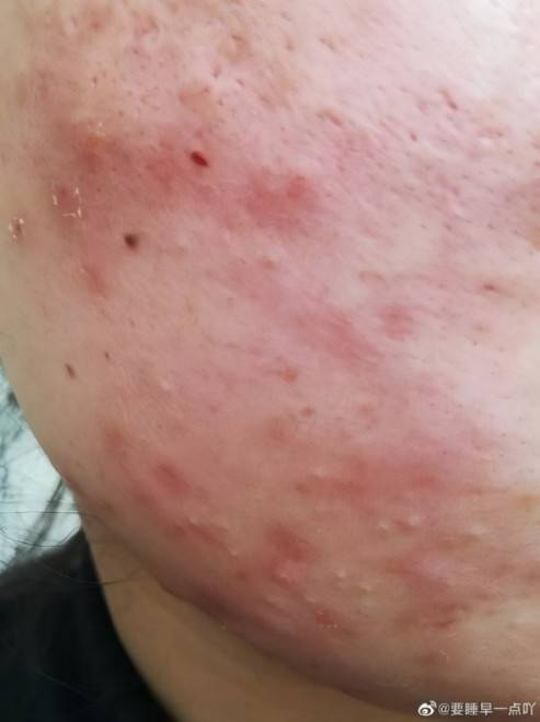 去痘控油洗面奶哪一款好?祛痘修护超给力